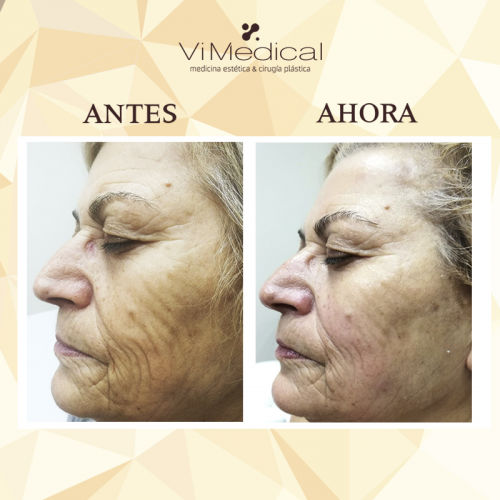 Tratamiento Pieles Maduras